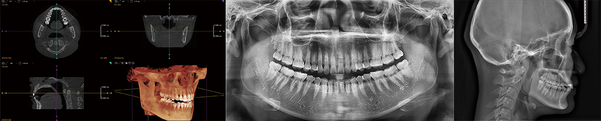 三合一CBCT全景,头侧,CT功能
