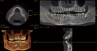 CBCT检查牙列
