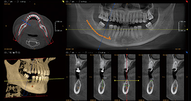 CBCT种植诊断