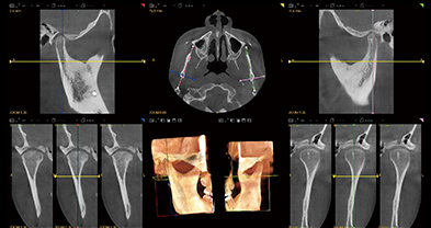 菲森CBCT用于TMJ区域诊断