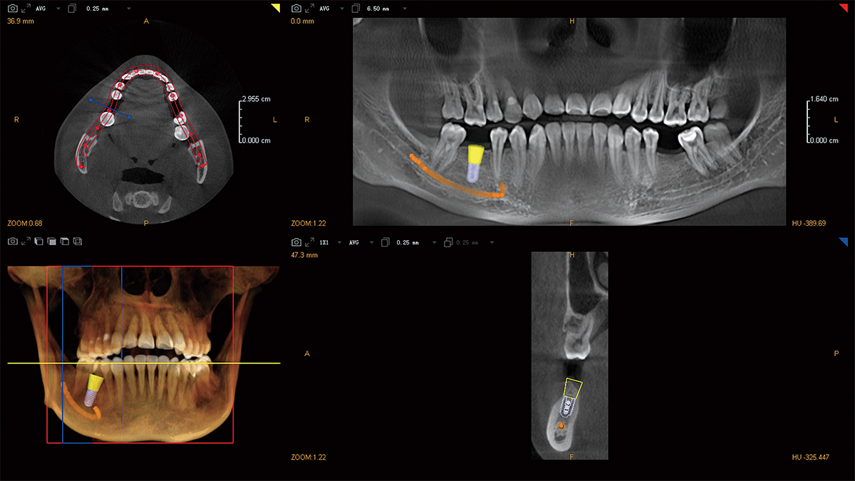 菲森三合一CBCT做模拟种植